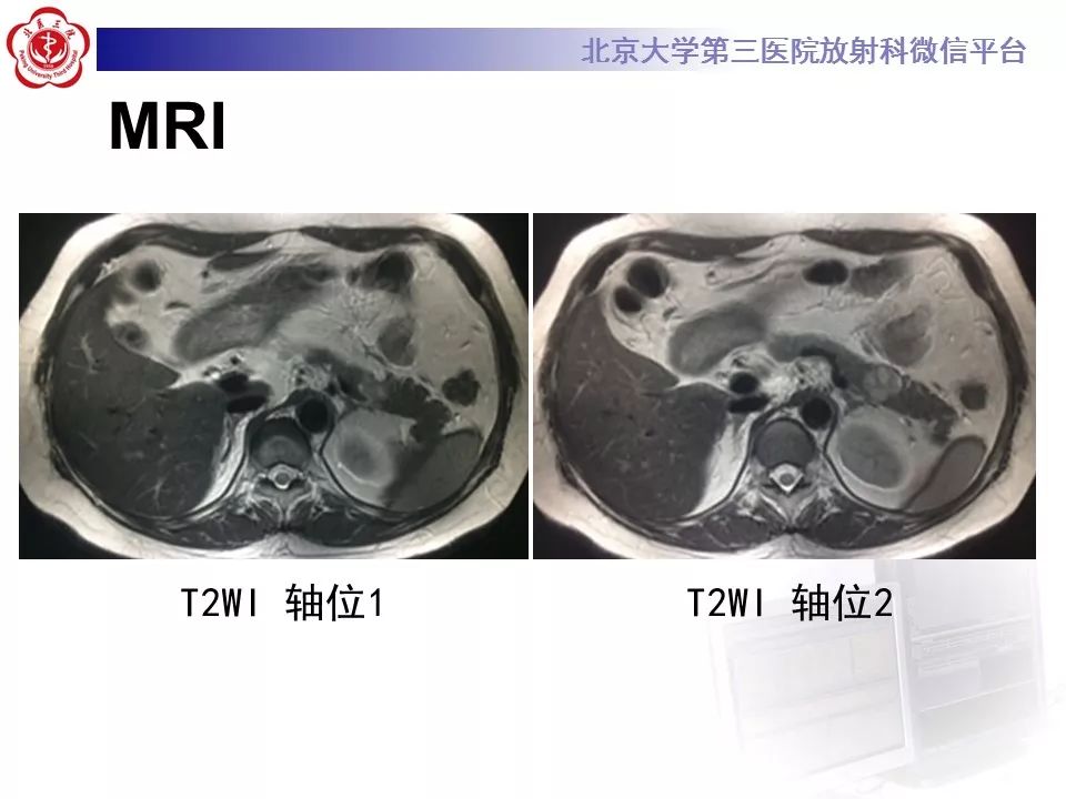 【病例】胰腺实性假乳头状瘤1例CT及MR影像诊断