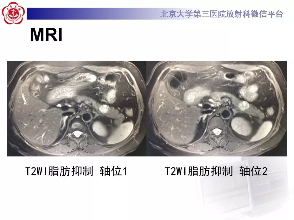 【病例】胰腺实性假乳头状瘤1例CT及MR影像诊断