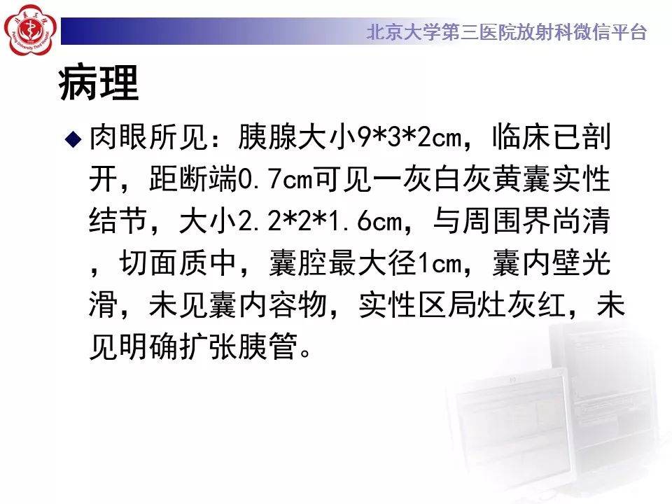 【病例】胰腺实性假乳头状瘤1例CT及MR影像诊断