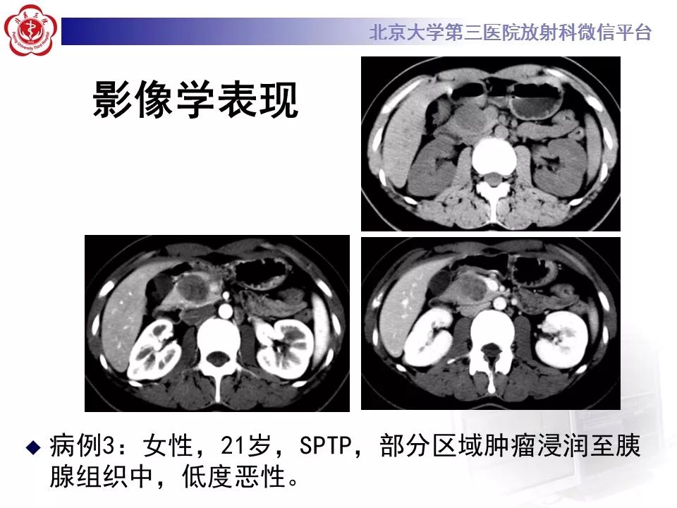 【病例】胰腺实性假乳头状瘤1例CT及MR影像诊断