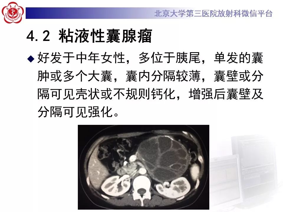 【病例】胰腺实性假乳头状瘤1例CT及MR影像诊断