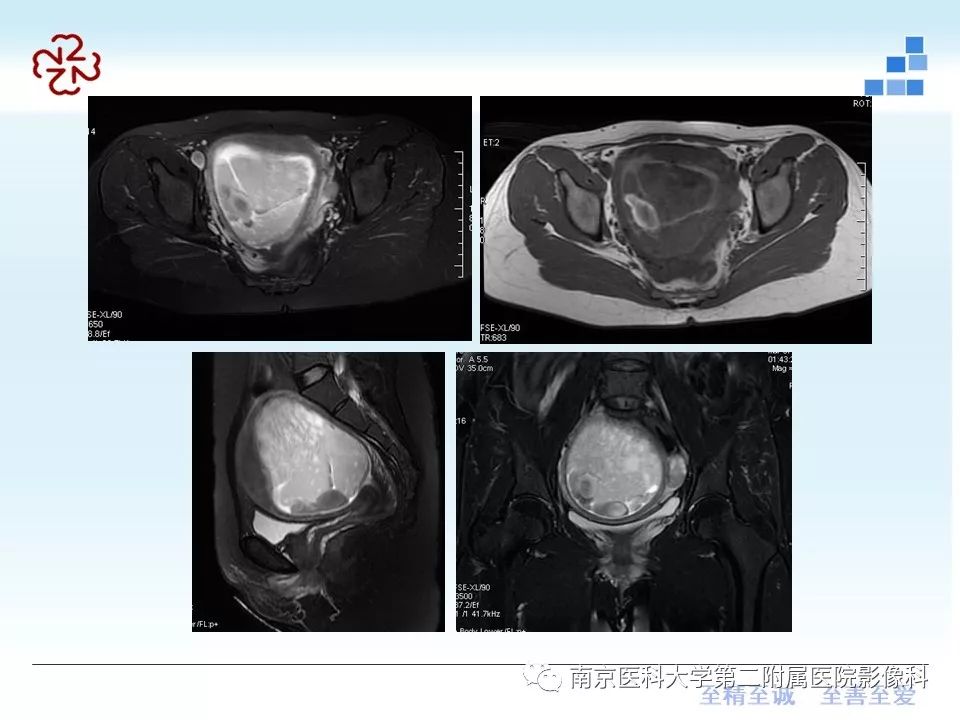 【PPT】葡萄胎的影像学诊断