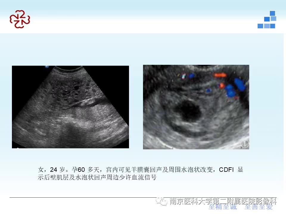 【PPT】葡萄胎的影像学诊断