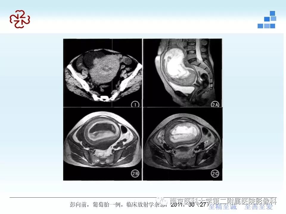 【PPT】葡萄胎的影像学诊断