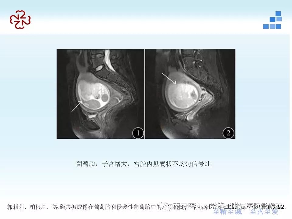 【PPT】葡萄胎的影像学诊断