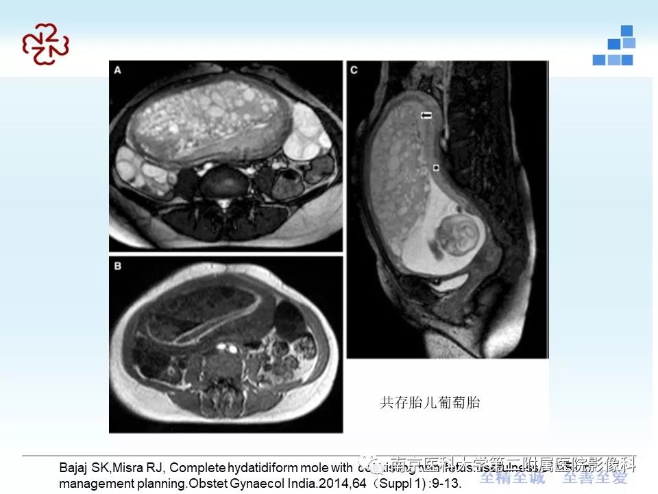 【PPT】葡萄胎的影像学诊断