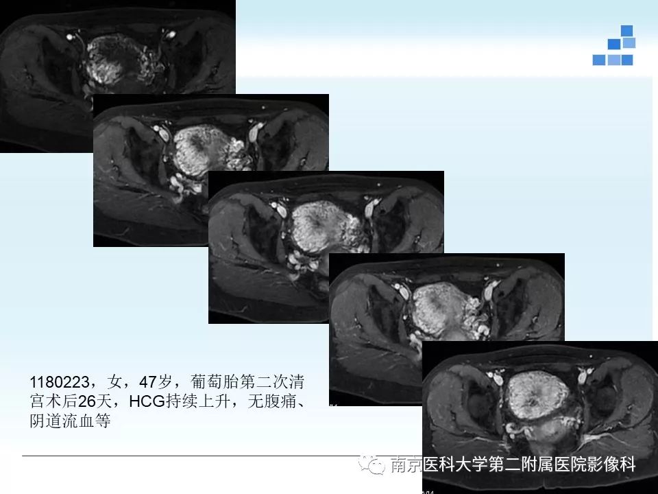 【PPT】葡萄胎的影像学诊断