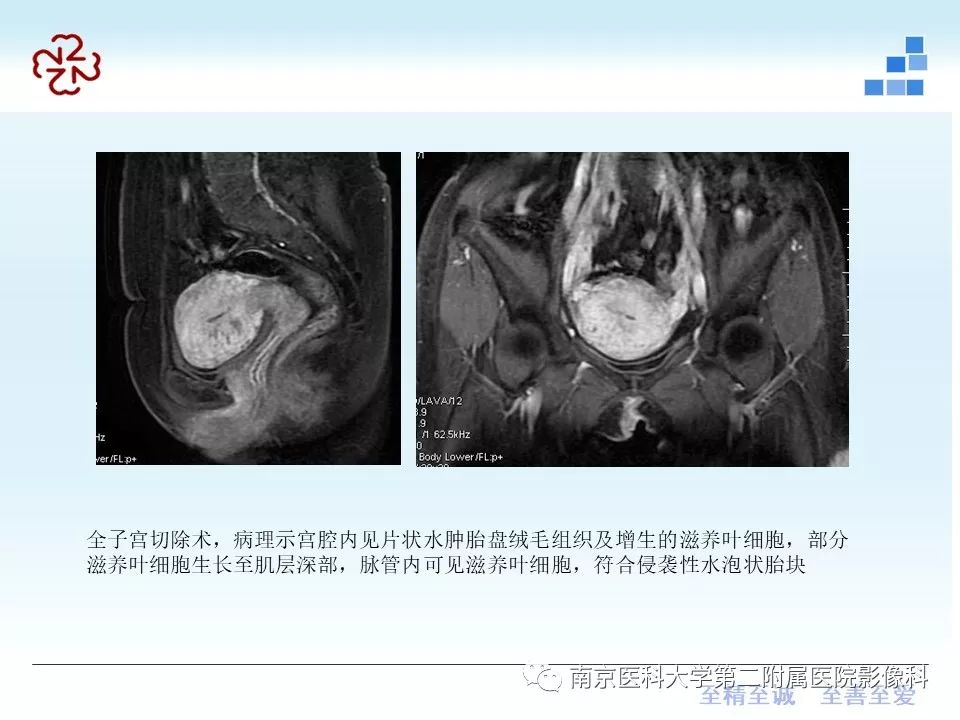 【PPT】葡萄胎的影像学诊断