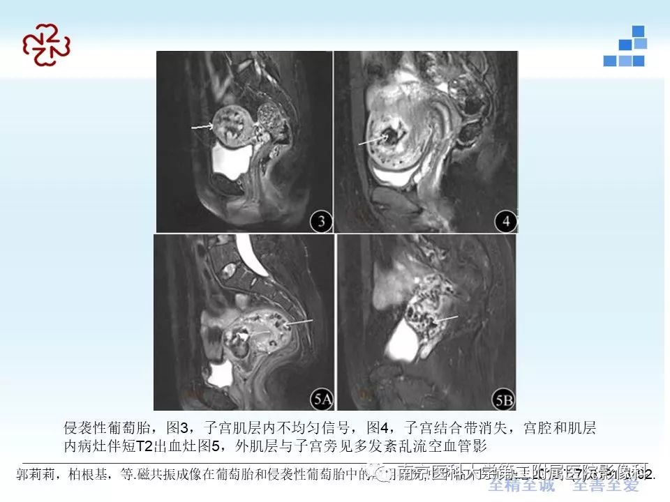 【PPT】葡萄胎的影像学诊断