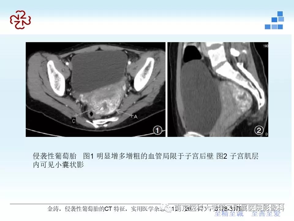【PPT】葡萄胎的影像学诊断