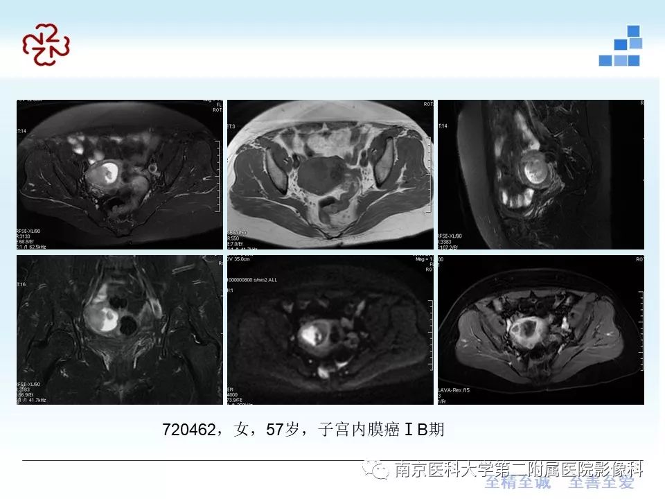 【PPT】葡萄胎的影像学诊断
