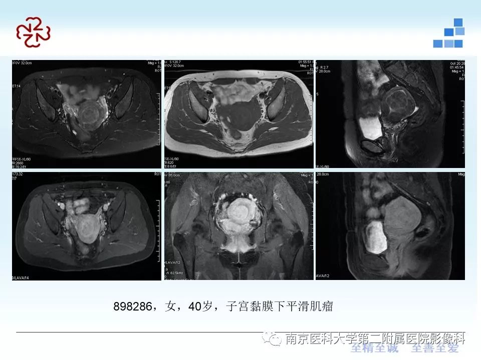 【PPT】葡萄胎的影像学诊断