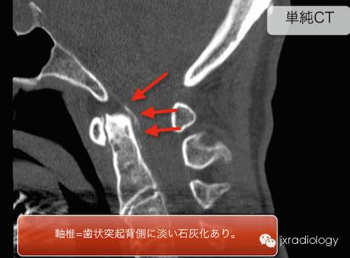 齿状突加冠综合征 齿状突加冠综合征