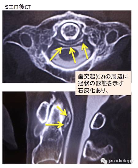 齿状突加冠综合征 齿状突加冠综合征