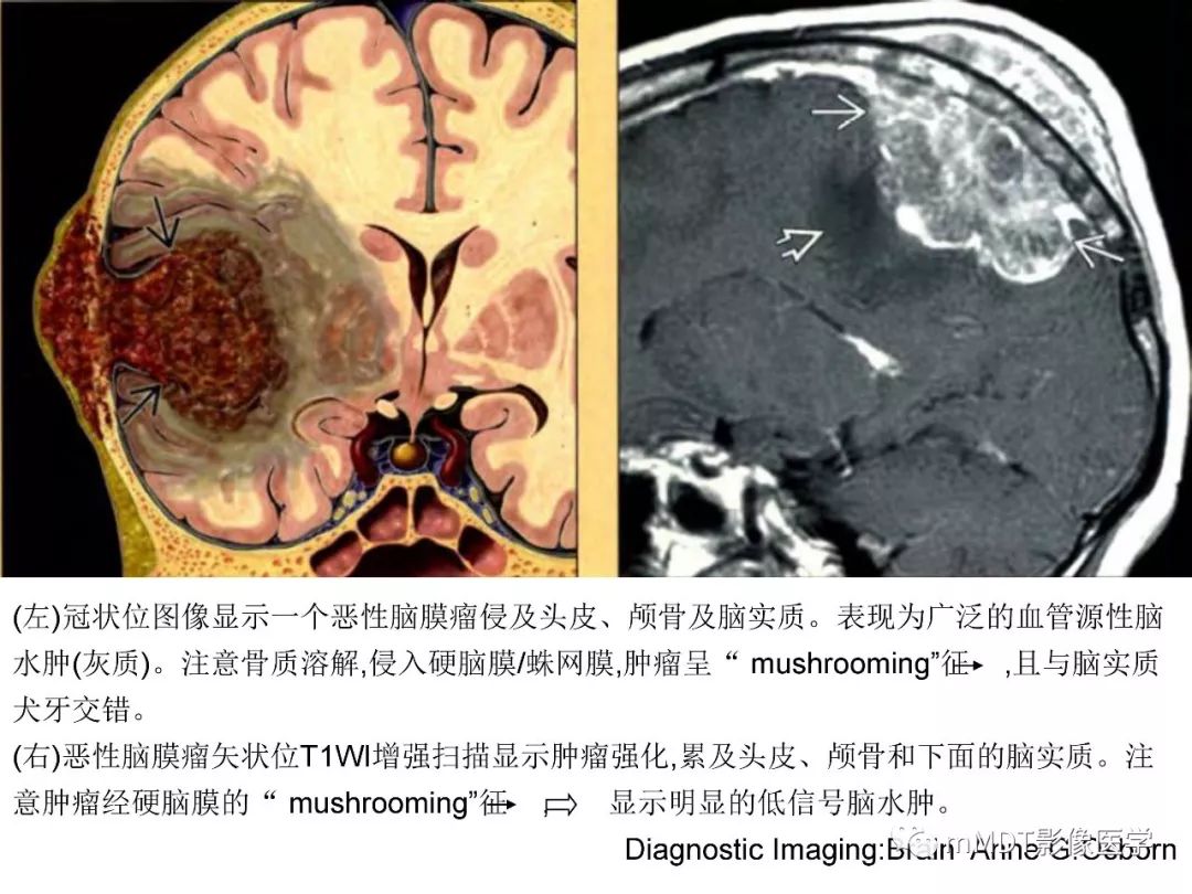 【PPT】脑膜肿瘤影像诊断1——脑膜瘤（脑膜上皮性）