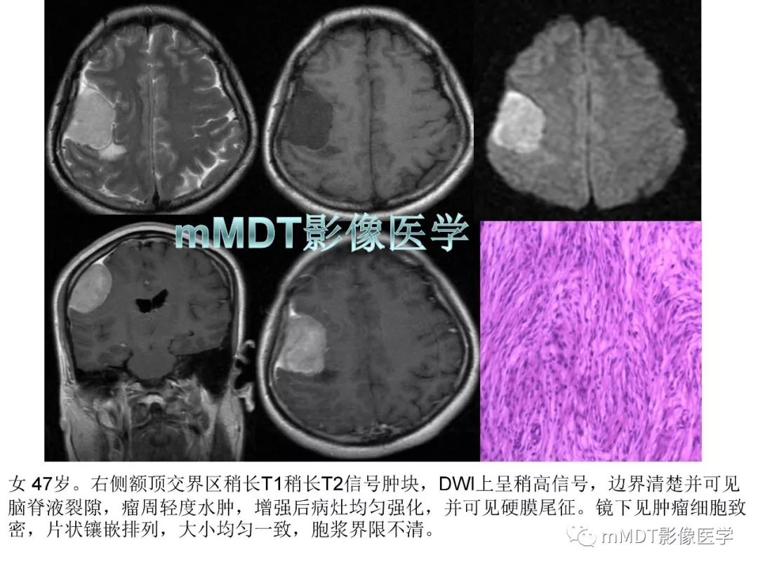【PPT】脑膜肿瘤影像诊断1——脑膜瘤（脑膜上皮性）