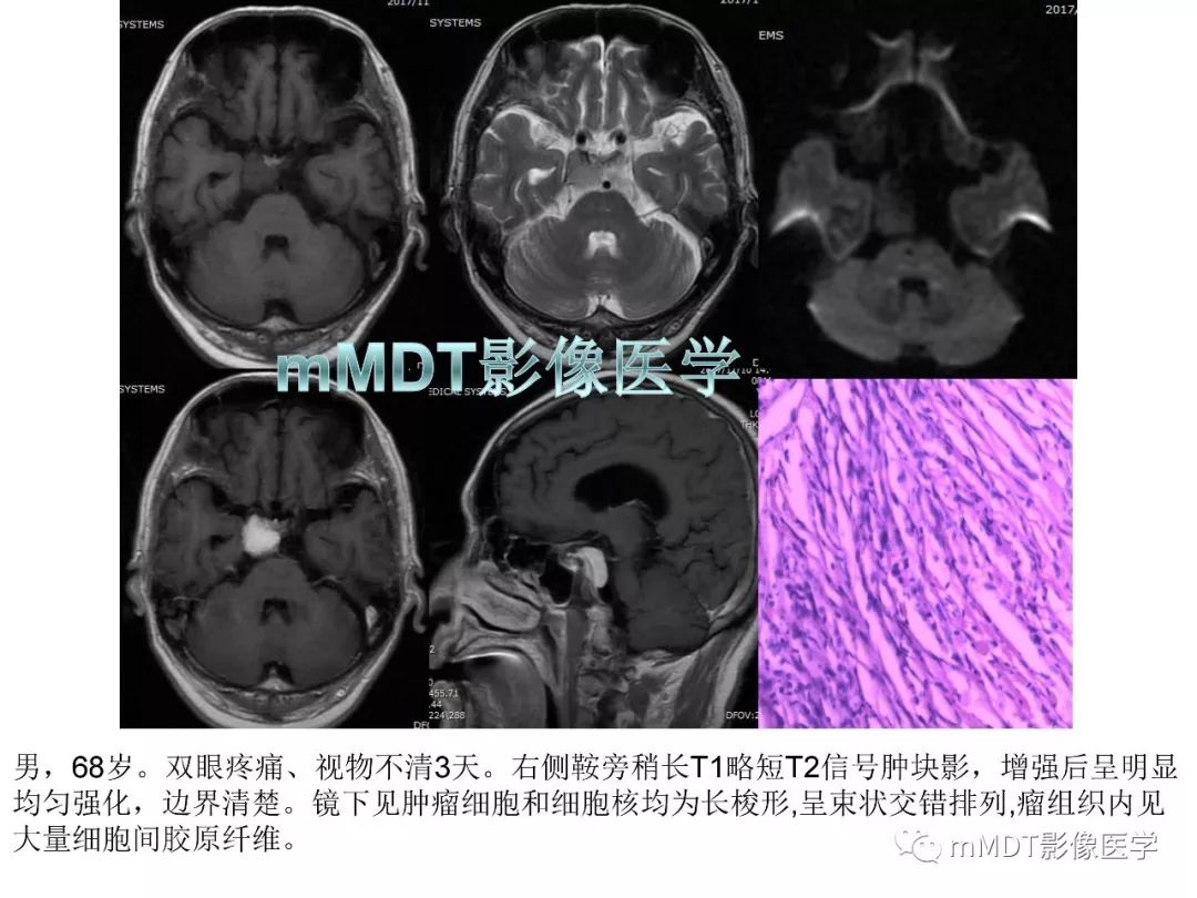【PPT】脑膜肿瘤影像诊断1——脑膜瘤（脑膜上皮性）