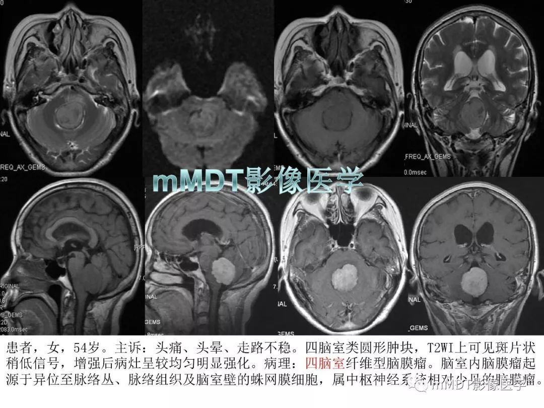 【PPT】脑膜肿瘤影像诊断1——脑膜瘤（脑膜上皮性）