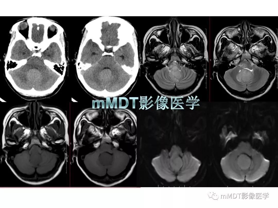 【PPT】脑膜肿瘤影像诊断1——脑膜瘤（脑膜上皮性）