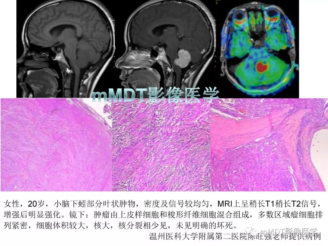 【PPT】脑膜肿瘤影像诊断1——脑膜瘤（脑膜上皮性）