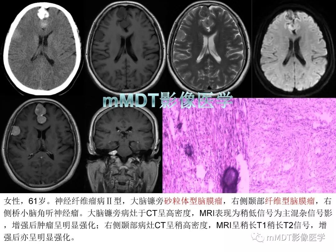 【PPT】脑膜肿瘤影像诊断1——脑膜瘤（脑膜上皮性）
