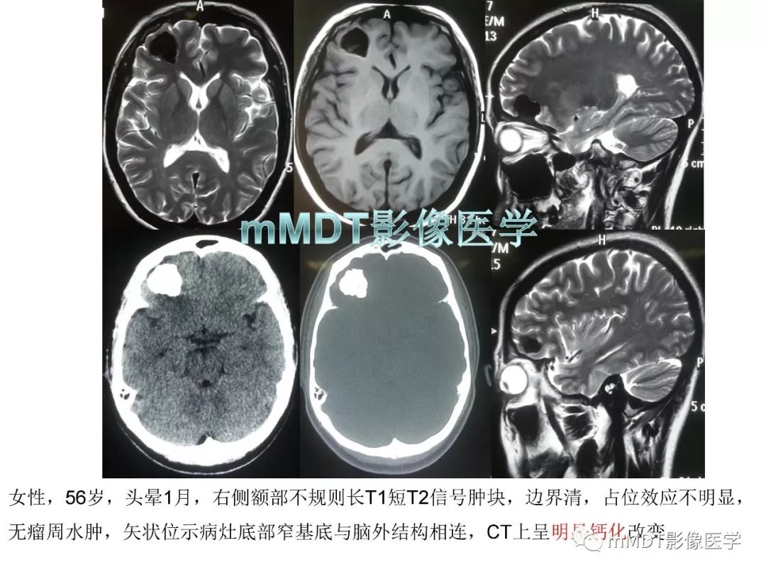 【PPT】脑膜肿瘤影像诊断1——脑膜瘤（脑膜上皮性）