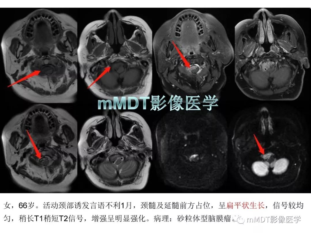 【PPT】脑膜肿瘤影像诊断1——脑膜瘤（脑膜上皮性）