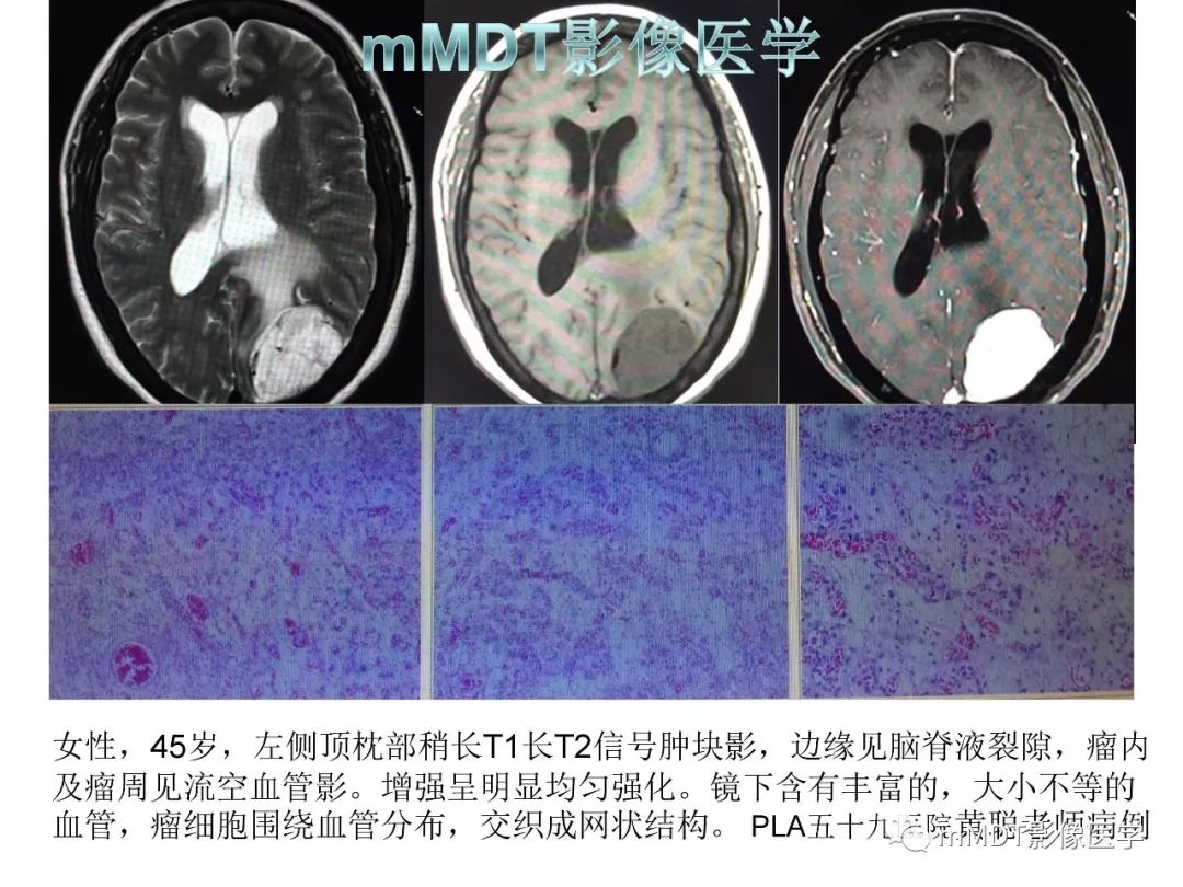 【PPT】脑膜肿瘤影像诊断1——脑膜瘤（脑膜上皮性）