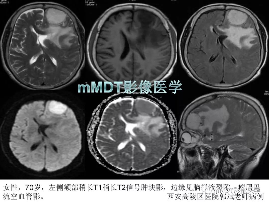 【PPT】脑膜肿瘤影像诊断1——脑膜瘤（脑膜上皮性）