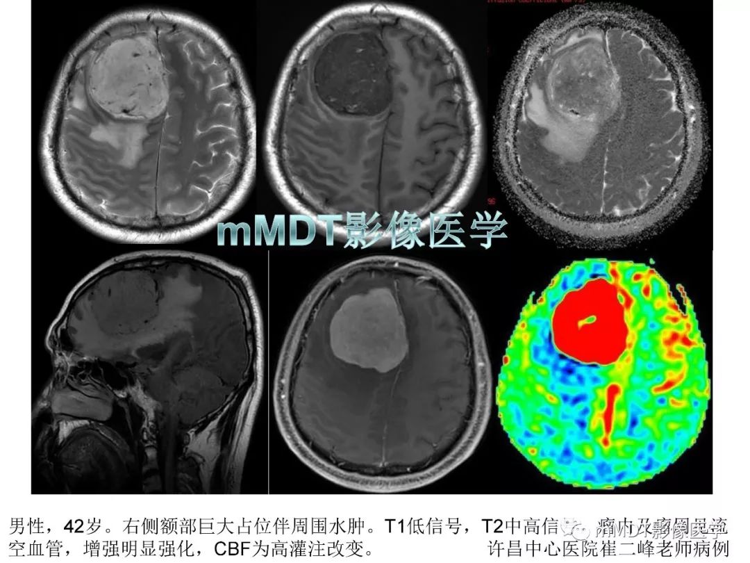 【PPT】脑膜肿瘤影像诊断1——脑膜瘤（脑膜上皮性）