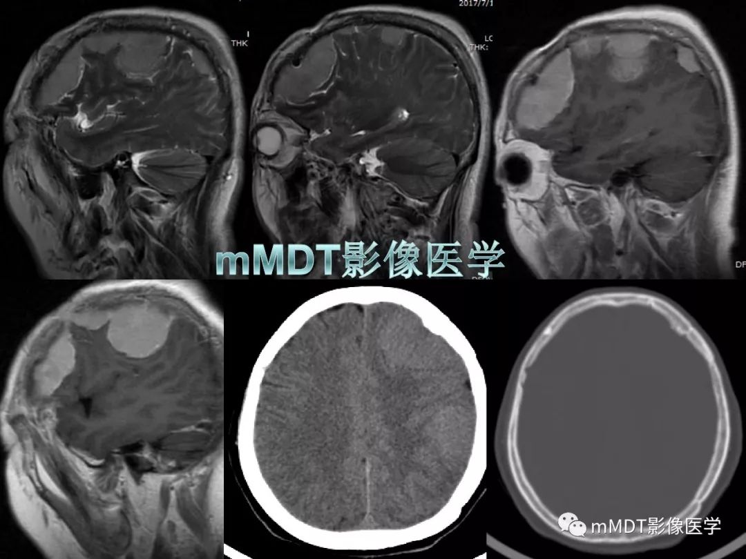【PPT】脑膜肿瘤影像诊断1——脑膜瘤（脑膜上皮性）