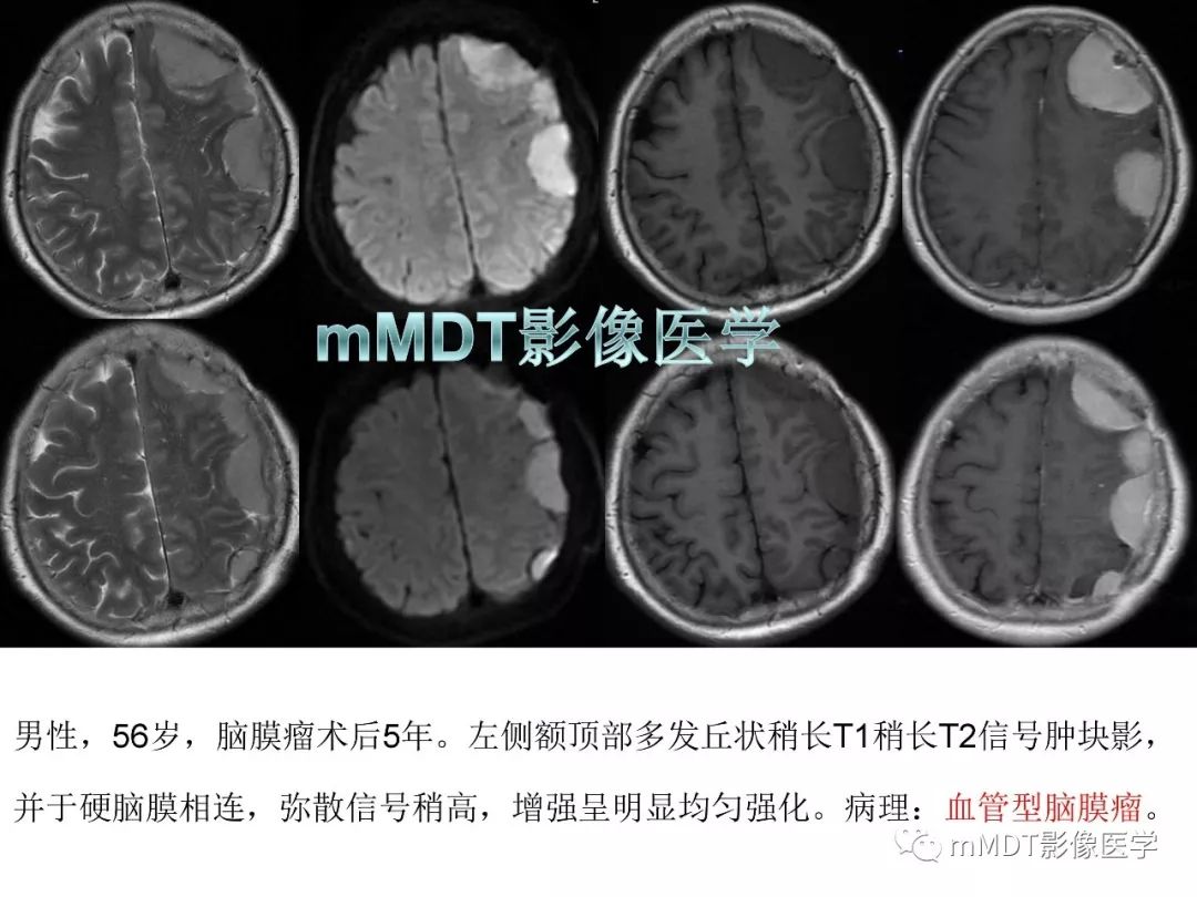 【PPT】脑膜肿瘤影像诊断1——脑膜瘤（脑膜上皮性）