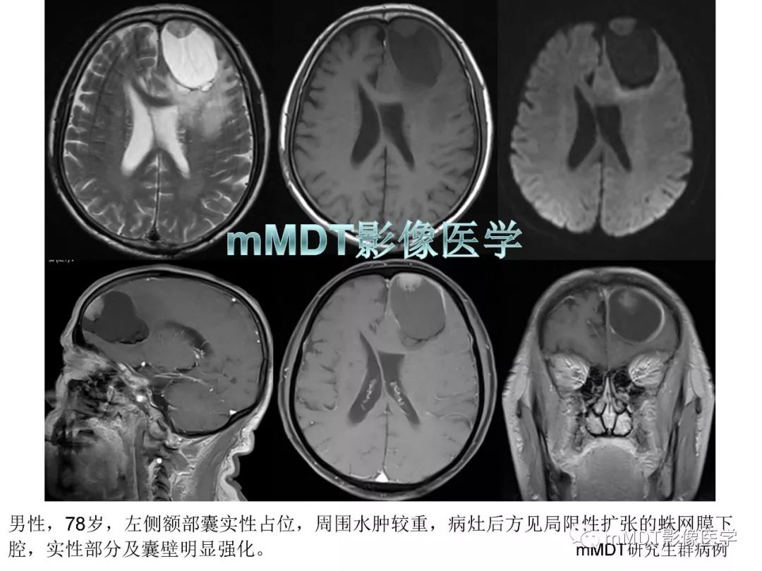 【PPT】脑膜肿瘤影像诊断1——脑膜瘤（脑膜上皮性）