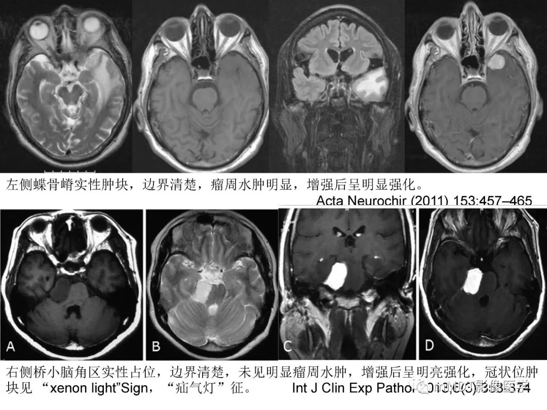 【PPT】脑膜肿瘤影像诊断1——脑膜瘤（脑膜上皮性）