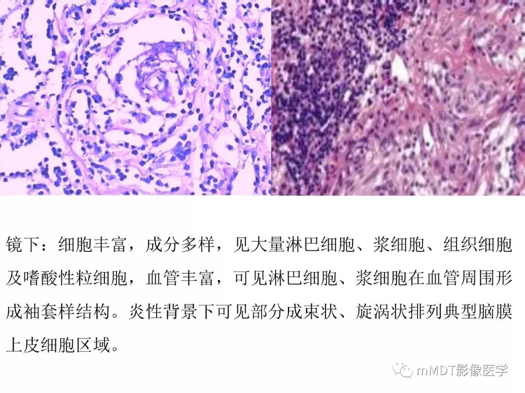 【PPT】脑膜肿瘤影像诊断1——脑膜瘤（脑膜上皮性）