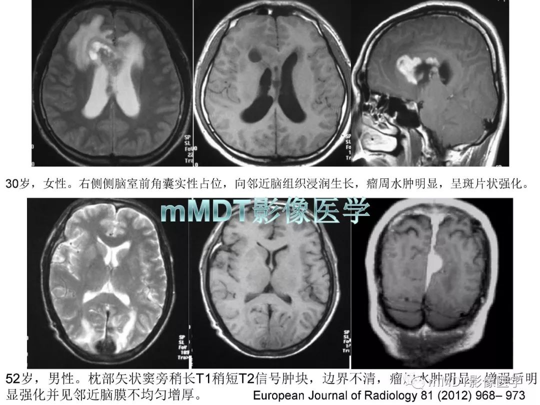 【PPT】脑膜肿瘤影像诊断1——脑膜瘤（脑膜上皮性）
