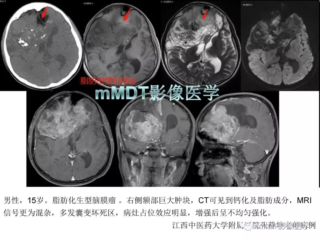 【PPT】脑膜肿瘤影像诊断1——脑膜瘤（脑膜上皮性）