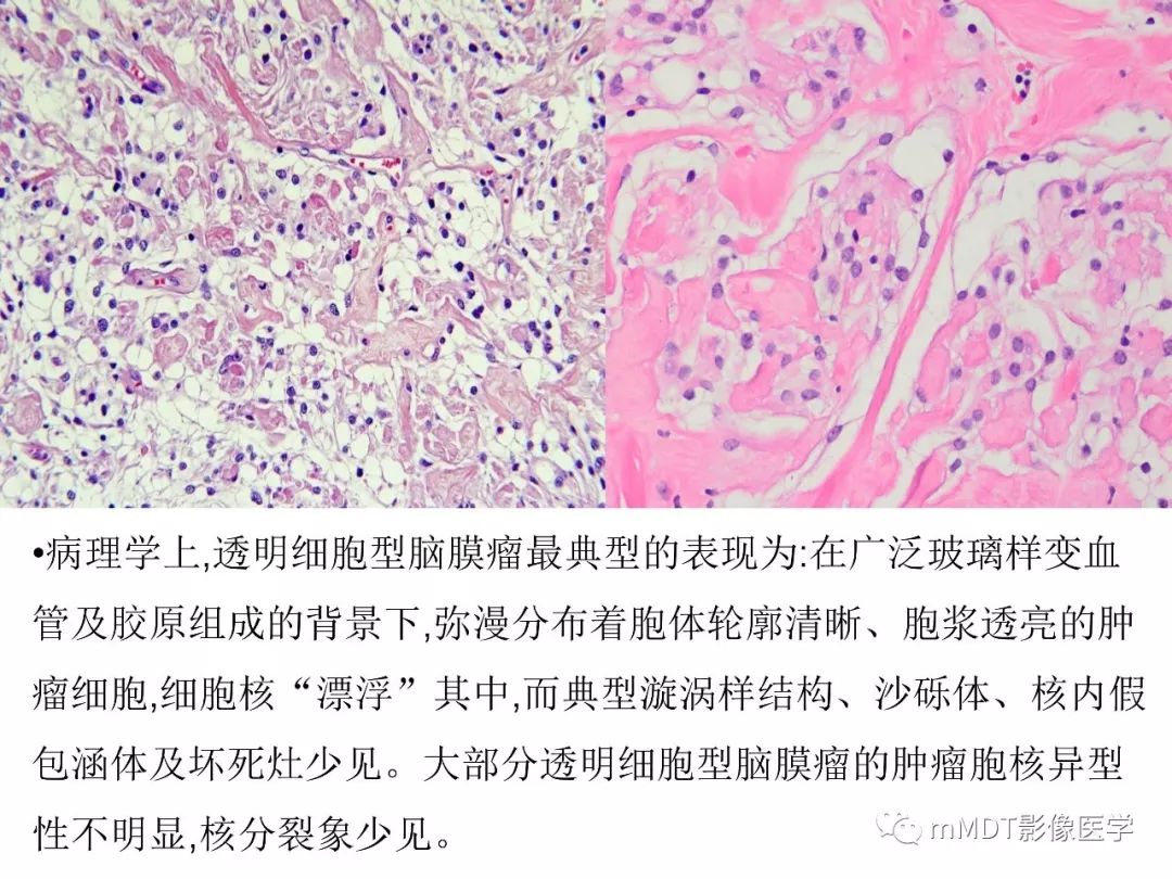 【PPT】脑膜肿瘤影像诊断1——脑膜瘤（脑膜上皮性）