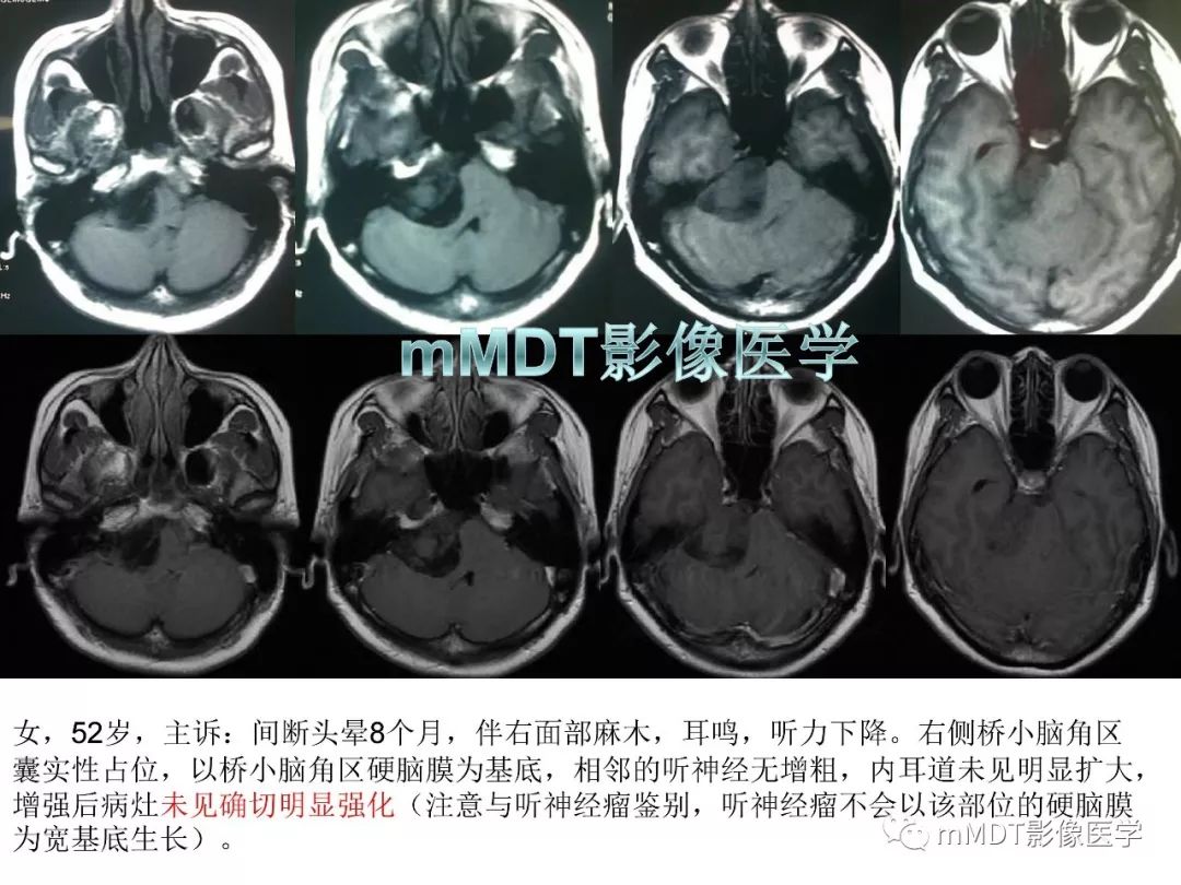 【PPT】脑膜肿瘤影像诊断1——脑膜瘤（脑膜上皮性）