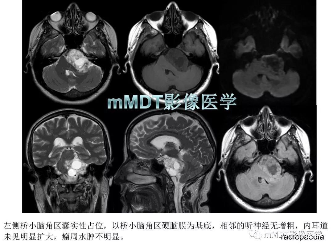 【PPT】脑膜肿瘤影像诊断1——脑膜瘤（脑膜上皮性）