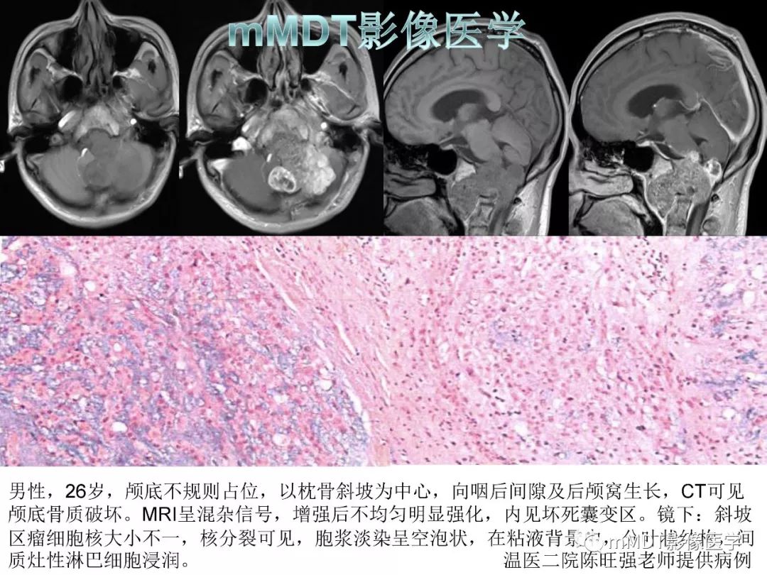 【PPT】脑膜肿瘤影像诊断1——脑膜瘤（脑膜上皮性）
