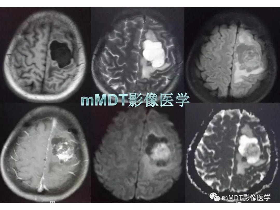 【PPT】脑膜肿瘤影像诊断1——脑膜瘤（脑膜上皮性）