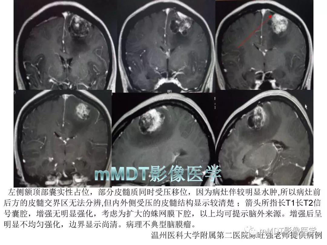 【PPT】脑膜肿瘤影像诊断1——脑膜瘤（脑膜上皮性）