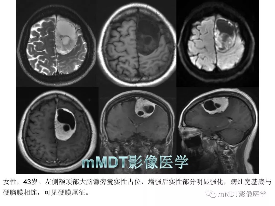 【PPT】脑膜肿瘤影像诊断1——脑膜瘤（脑膜上皮性）