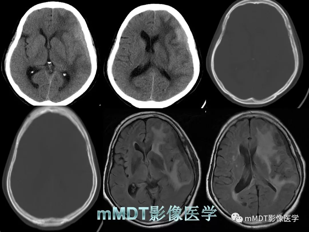 【PPT】脑膜肿瘤影像诊断1——脑膜瘤（脑膜上皮性）