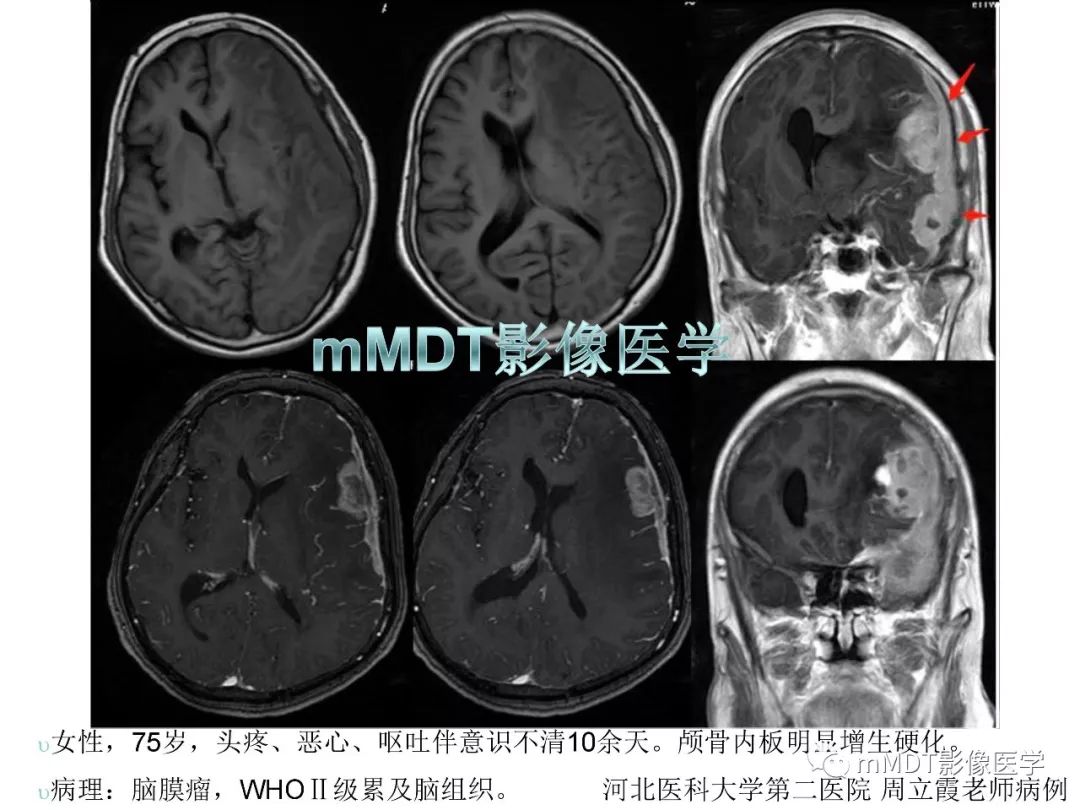 【PPT】脑膜肿瘤影像诊断1——脑膜瘤（脑膜上皮性）