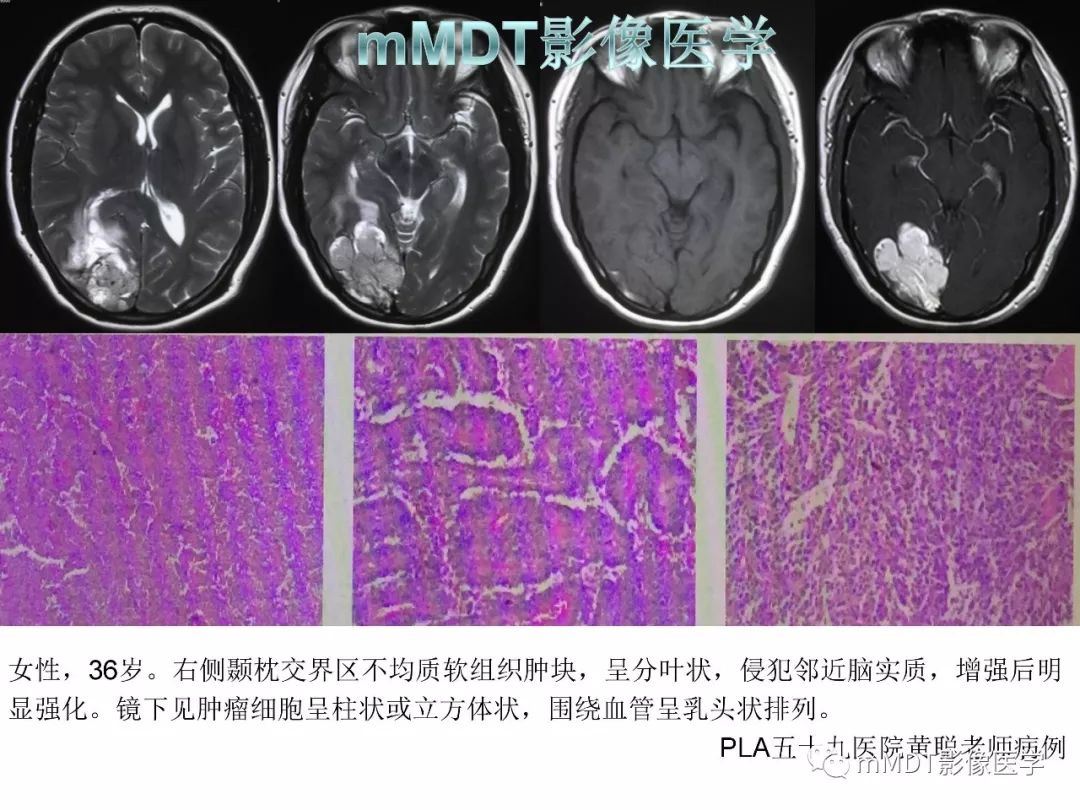 【PPT】脑膜肿瘤影像诊断1——脑膜瘤（脑膜上皮性）