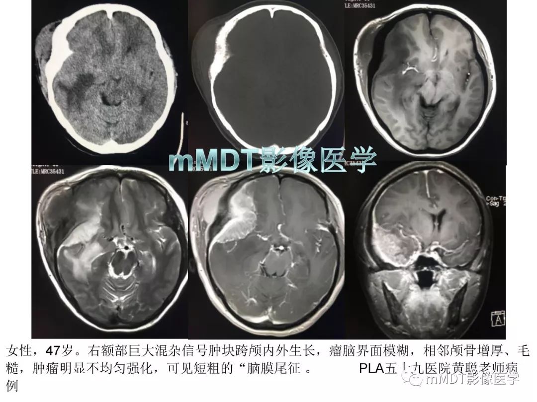 【PPT】脑膜肿瘤影像诊断1——脑膜瘤（脑膜上皮性）