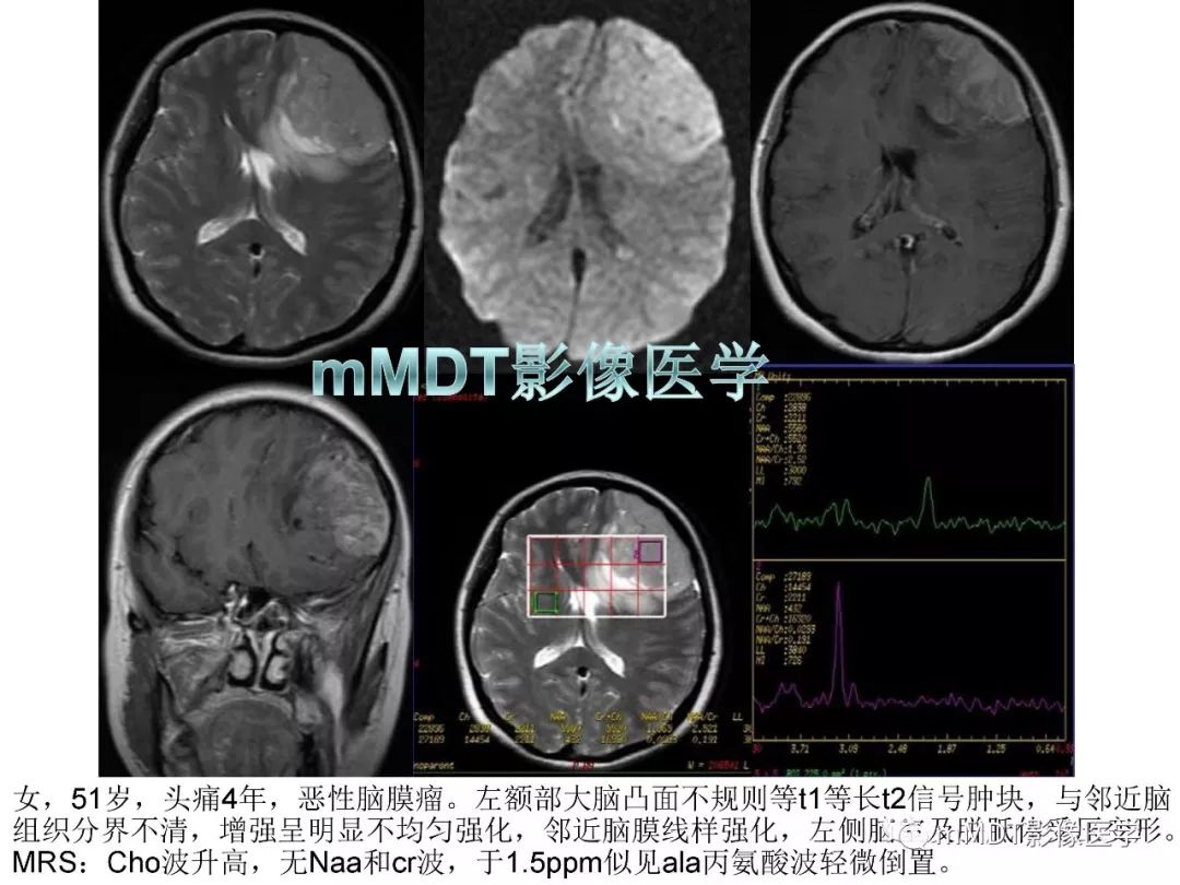 【PPT】脑膜肿瘤影像诊断1——脑膜瘤（脑膜上皮性）