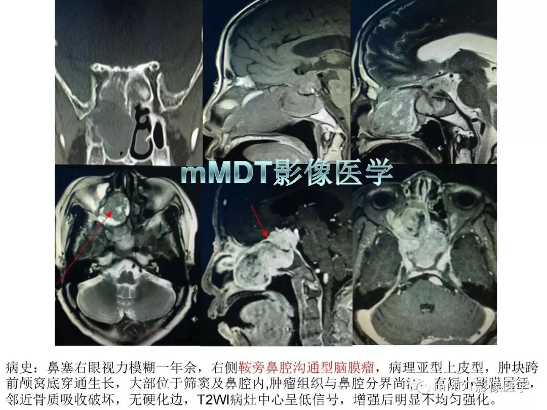 【PPT】脑膜肿瘤影像诊断1——脑膜瘤（脑膜上皮性）